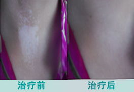 福州皮肤病院攻略