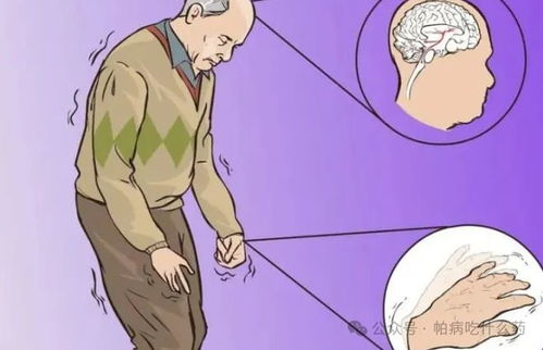 治疗帕金森的游戏有哪些