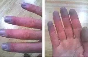 突然降温女生手指被冻成白色