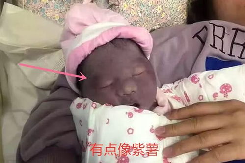 出生2天被护士烫伤宝宝长新皮肤